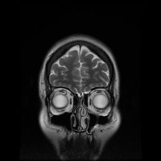 an x - ray image of a human skull's head with the brain visible