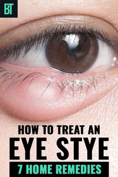 All you need to know about eye styes. How to treat an eye stye at home with one of 7 home remedies shared, and what caused it in the first place to appear. Get Rid Of Stye, Stye Remedy, Back Acne Remedies, Different Types Of Acne, Blind Pimple, Bad Acne, Pimples Remedies, Natural Acne Remedies