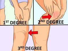 The human body is composed of seven ligaments that go through and around the knee. These ligaments are necessary to maintain stability in the body's joints. Two of these ligaments are more vulnerable to injuries compared to others. These... Knee Sprain Recovery, Mcl Sprain Recovery, Pulled Muscle In Leg, Mcl Injury Recovery, Mcl Strain Knee Exercises, Ligaments Of The Knee, Knee Ligament Strengthening Exercises, Knee Sprain, Knee Ligament Tear Exercises