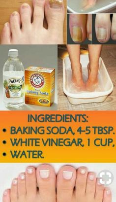 Dry Feet Remedies, Foot Soak Recipe, Natural Skin Care Remedies, Baking Soda Shampoo, Toenail Fungus, Skin Care Remedies, Natural Health Remedies, Healthy Skin Care