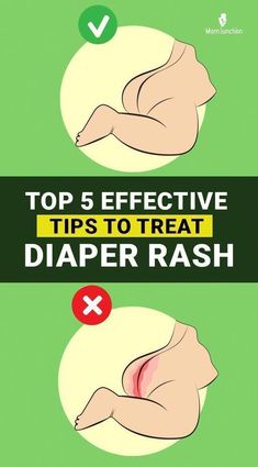 Diaper rash, also known as diaper dermatitis (DD), is an inflammation of the skin covered by the diaper, in neonates and infants (1). At times, the diaper rash could get infected by a fungus called candida, commonly called yeast. The rash is then called a yeast diaper rash. African Babies, Mom Junction, Healthy Happy, Baby Care, Infants, Diy Baby Stuff, Yeast, Parenting Hacks