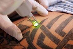 a man getting laser tattoo on his arm and neck with green light coming from the needle