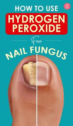 How To Use Hydrogen Peroxide For Nail Fungus: Oxidative therapy incorporates the use of hydrogen peroxide to treat nail fungus. Keep reading to know more about how this works and how to use hydrogen peroxide for nail fungus treatment. #hydrogenperoxide #nailfungus #nailcare #nailcaretips Hydrogen Peroxide Uses, African Tribe