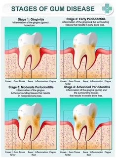 Gingivitis is the most common form of gum disease. This article looks at how to get rid of gingivitis quickly, from home remedies to medical mouthwashes..
#dentalhealth, #dentalhealthcare Gum Diseases Chart, Bone Loss