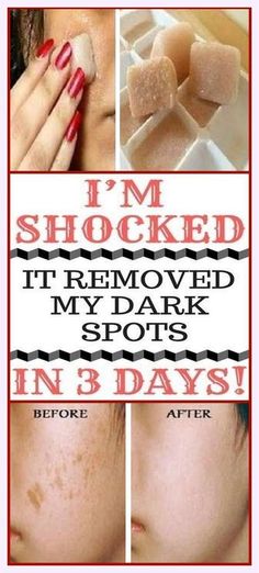 I’m SHOCKED It Removed My Dark Spots In 3 Days, Magic Remedy Skin Care Remedies, Skin Care Recipes