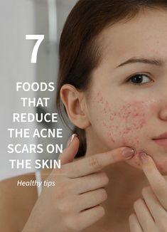 Acne Mark Removal, Skin Foods, Acne Scar Removal Cream, Acne Scar Remedies, Acne Scar Mask, Acne Scaring, Skin Care Home Remedies, Scar Removal Cream