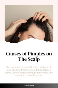 Discover the Causes of Pimples on The Scalp and effective treatments with this detailed guide. Learn expert insights, practical tips, and FAQs for a healthier scalp. Causes Of Pimples, What Causes Pimples, Pimples On Scalp, Pimple Causes, Exfoliate Scalp, Fresh Aloe Vera Gel, Clean Scalp, Oily Scalp