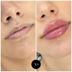 Lips Inspiration, Face Fillers, Botox Filler, Botox Lips, Natural Mouthwash, Facial Fillers, Facial Contouring, Beauty Lips, Facial Aesthetics