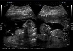 an x - ray shows two different views of the breast