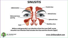 Discover effective methods for rapidly relieving and alleviating symptoms of acute sinusitis with the help of our expert tips. Our comprehensive guide covers a range of proven treatments to help you find quick and lasting relief. Acute Sinusitis, Sinus Inflammation, Relieve Sinus Pressure, Maxillary Sinus, Saline Nasal Spray, Chronic Sinusitis, Sinus Pressure, Cerebrospinal Fluid, Acne Solutions