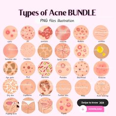 Acne Illustration, Skincare Icon, Skincare Illustration, Facial Esthetics, Different Types Of Acne, Skin Facts, Skin Advice, Acne Oil, Types Of Acne