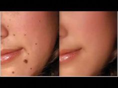 How to make things Skin Tags On Face, Moles On Face, Warts On Face, Remove Skin Tags Naturally, Remove Warts, Skin Moles, Mole Removal, Skin Tags, Diy Remedies