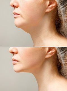 Aesthetic Before And After, Double Chin Before And After, Cosmetic Surgery Aesthetic, No Double Chin, Before And After, Double Chin Surgery, Plastic Surgery Aesthetic, Chin Surgery, Photo Cosmetic