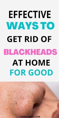 Best Blackhead Remover, Blackhead Remedies, Good Skincare, Black Heads, Home Remedy For Cough, Natural Sleep Remedies