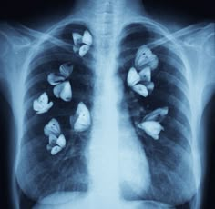 an x - ray shows the lungs with butterflies on it's chest and back