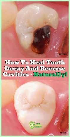 You’re the best! Enjoyable  info! Reverse Cavities Naturally, Teeth Decay, Turmeric Tea Recipe, Reverse Cavities, Tooth Cavity, Homemade Toothpaste, Heal Cavities, Dental Health Care, Pasta Dental