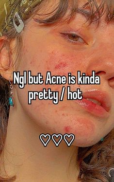 Tips to Prevent Pimples - SKINCARE by AGNESA MOORE | This newsletter was created with Smore, an online tool for creating beautiful newsletters for educators, nonprofits, businesses and more Pretty Acne Aesthetic, Acne Insecurities, Acne Whisper, Pretty People With Acne, Don't Be Insecure, Acne Pretty, Strawberry Freckles, Acne Aesthetic, Acne Positivity