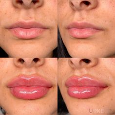 Lip filler before and after by UPKEEP Med Spa. Find more lip filler inspo and beauty aesthetics on our page or on our instagram! Book a free consult with us on our website. Before And After Lip Fillers, Lip Filler Before And After, Face Fillers, Botox Fillers