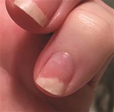 I injured my nail causing it to lift from the nail bed. Is the nail damaged for good? - Health - NAILS Magazine Nail Damage Remedies, Nail Bed Damage, Toenail Problems, Nail Disorders, Nails After Acrylics, Black Halloween Nails, Ingrown Nail