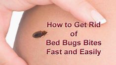 a bed bug sitting on the side of a woman's stomach with text overlay how to get rid of bed bugs bites fast and easily