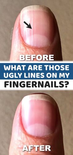 As I’ve gotten older, those vertical ridges on my nails seem to be getting more and more prominent. I really noticed those ugly lines recently in the food pictures on my blog. That’s when I decided to do some research to see if those ridges meant anything about my health, and if there was anything I could do to get rid of them. It turns out, they are most likely due to simply getting older (kind of like wrinkles), but can also mean a deficiency. Nail Health Signs, Nail Ridges, Nail Problems, Health Signs, Tongue Health, Nail Care Tips, Lines On Nails, Brittle Nails, Getting Older