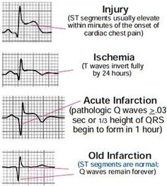 Ekg Interpretation, Cardiology Nursing, Nursing Information, Critical Care Nursing, Nursing Mnemonics, Emergency Nursing