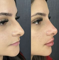 Nose Rhinoplasty, Nose Surgery Rhinoplasty, Nose Job Inspo, Nose Fillers, Dream Nose, Plastic Surgery Fail, Nose Reshaping, Rhinoplasty Nose Jobs, Face Fillers