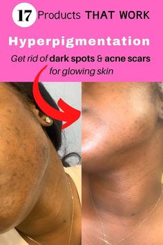 We've rounded up 17 of the best products for hyperpigmentation treatment from Black-Owned beauty brands to treat skin discoloration! Hyperpigmentation Remedies, Products For Hyperpigmentation, Hyperpigmentation Black Skin, Hyperpigmentation Serum, Skin Hyperpigmentation, Fade Dark Spots, How To Get Rid Of Acne, Skin Discoloration