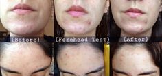 I tested out Jojoba Oil on my oily, acne prone skin, and documented what happened (post includes before/after photos and a discussion on the "oil cleansing method"). Jojoba Oil For Acne, Jojoba Oil Benefits For Skin, Acne Pit Scars, Acne Scar Mask, Jojoba Oil Benefits, Oily Acne Prone Skin, Clear Skin Fast, Oil Cleansing Method