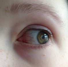 a close up of a child's eye with red marks on the outside of it