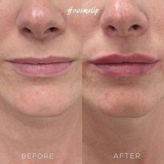 Lip Fillers Before And After 1ml, Natural Lip Fillers, Lip Inspiration, Lip Job, Hyaluronic Acid Lips, Lip Types, Hydrated Lips