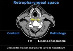 an mri scan shows the location of the retransferinal space in the brain