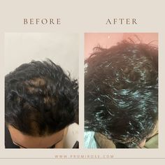 There are many issues that can contribute to hair thinning or fallout (stress, lack of sleep, vitamin deficiencies, hormonal changes, impaired microcirculation, pregnancy, and poor scalp health). Frequently, it's a combination of two or more of these issues. Our natural ingredients in our Hair oil use are a combination of clinically-tested, vegan plants actives that work in tandem to help support a healthy and balanced follicular ecosystem while soothing the scalp and revitalizing hair roots. Fr Hair Growth Oils, Natural Hair Growth Oil, Hair Roots, Hair Thinning, Scalp Health, Hormonal Changes, Nail Health, Growth Oil, Dynamic Duo