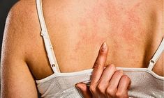 a woman holding her hand up to the back of her shoulder with red spots on it