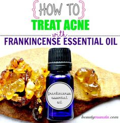 Benefits of frankincense essential oil & recipes for acne! Essential Oil Face Mask, Frankincense Essential Oil Uses, Essential Oils For Nausea, Frankincense Benefits, Pimples Overnight, Ginger Essential Oil, Frankincense Oil