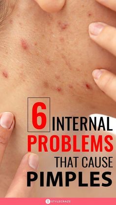 Name one thing that occurs at some stage in almost everybody’s life. Before you torment yourselves for the answer, let me tell you, it is acne. Breaking Out On Chin, Hard Pimple, Clear Acne Fast, Pimple Solution, Get Rid Of Pimples, Blind Pimple, Rid Of Pimples, How To Help Nausea