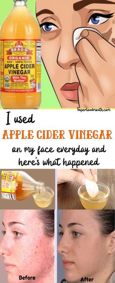 Apple Cider Vinegar For Acne, Acv Toner, Apple Cider Vinegar Toner, Cider Vinegar Benefits, Apple Cider Vinegar For Skin, Apple Cider Vinegar Benefits, Vinegar Uses, Apple Cider Benefits, Organic Apple Cider