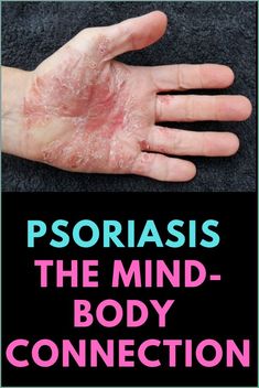 Psoriatic Skin, Dna Code, Wealth Dna Code, Health And Wealth, Skin Patches, Wealth Dna, Healing Hands, Mind Body Connection, Physical Development