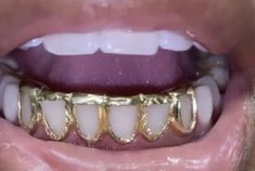 an open mouth with gold teeth and braces