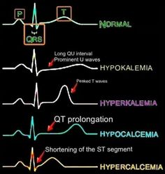 the ecd and cardioly study cards have different types of hypocaliaia