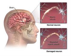 ANerv_20140205_v2_001 Nerve Conduction Study, Multiple Sclerosis Symptoms, Guillain Barre, Guillain Barre Syndrome, Ms Symptoms, Peripheral Nervous System, Decrease Inflammation