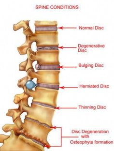 Sciatica-related lower back pain is caused by an inflammation of the sciatic nerve, which runs from the spinal cord through the hip area and down the back of each leg. Sciatica Pain, Sciatic Nerve, Chiropractic Care, Med Student