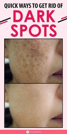 Lighten Dark Spots