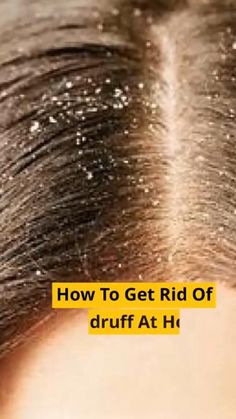 DIY Dandruff treatment has been one of the most sought-after ways of getting rid of stubborn dandruff and dry scalps. Dandruff is a very common skin condition called Seborrheic dermatitis affecting people of both genders. It causes itchiness, greasy patches, and white flakes of skin which could be caused by psoriasis, eczema, hair product sensitivity, and overgrown fungus. #Dandrufftreatment #haircare #health #diyhealthplus #homeremedy #hack #health #hair #dandruffs Itchy Scalp Remedy, Aloe Vera Gel Face, Hair Mask For Dandruff, Home Remedies For Dandruff, Dandruff Remedy, Natural Remedies For Migraines, Getting Rid Of Dandruff, Health Plus, Dry Skin Remedies