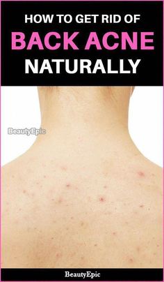 Get Rid Of Back Acne, Rid Of Back Acne, Warts On Hands, Warts On Face, How To Remove Warts, Remove Warts, Back Acne, Get Rid Of Warts, Cold Sores Remedies