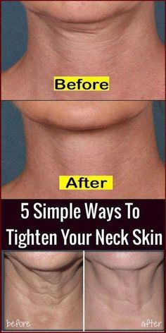 Natural Wrinkle Remedies, Chest Wrinkles, Wrinkle Remedies