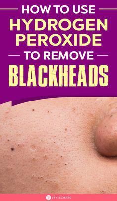 Hydrogen peroxide is the universal go-to ingredient when it comes to skincare. Read this article to how to use hydrogen peroxide to remove blackheads safely. Recipe Hacks, To Remove Blackheads, Home Remedy For Cough, Cold Sores Remedies, Eye Exercises, Weight Changes, Remove Blackheads, Natural Sleep Remedies, Natural Cold Remedies