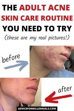 Acne Solutions That Work, Papules Acne, Acne Skin Care Products, Acne Skin Care Routine, Acne Prone Skin Care, Best Acne Products, Acne Skincare Routine, Natural Acne Remedies