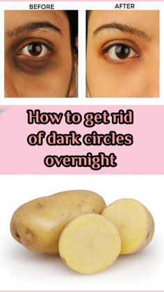 Dark circles causes and treatment. Remedies help to remove dark circles under your eyes. Home remedies help to remove dark circles. Potato For Dark Circles, Dark Circle Remedies Overnight, Gallbladder Removal, Dark Circle Remedies, Dark Circles Around Eyes, Brown Spots On Skin, Wrinkle Remedies, Dark Eye Circles, Brown Spots Removal