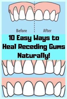 Tremendous details Natural Remedies For Allergies, Ways To Heal, Periodontal Disease, Hygiene Routine, Dental Problems